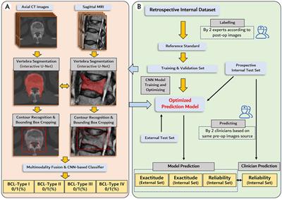 Deep learning-based multimodal image analysis predicts bone cement leakage during percutaneous kyphoplasty: protocol for model development, and validation by prospective and external datasets